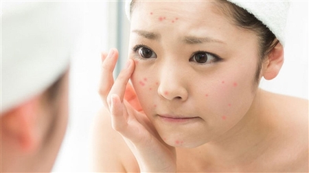 Tàn phai nhan sắc cho mỹ phẩm chứa Corticoid
