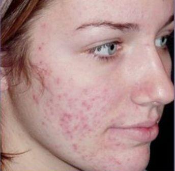 Tác hại của việc trị mụn bằng sản phẩm chứa Corticoid