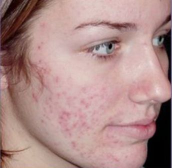 Tác hại của việc trị mụn bằng sản phẩm chứa Corticoid