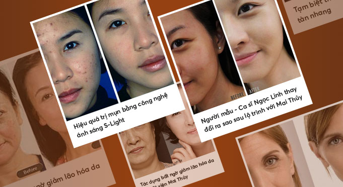 Hinh anh truoc sau